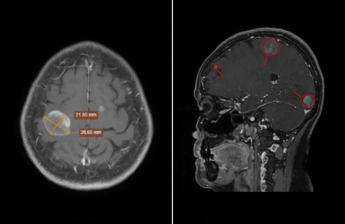 Ảnh chụp MRI não bằng hệ thống 3 Tesla Signa Hero cho thấy các khối u di căn xuất hiện tại não. Ảnh: Phòng khám Đa khoa Tâm Anh Quận 7