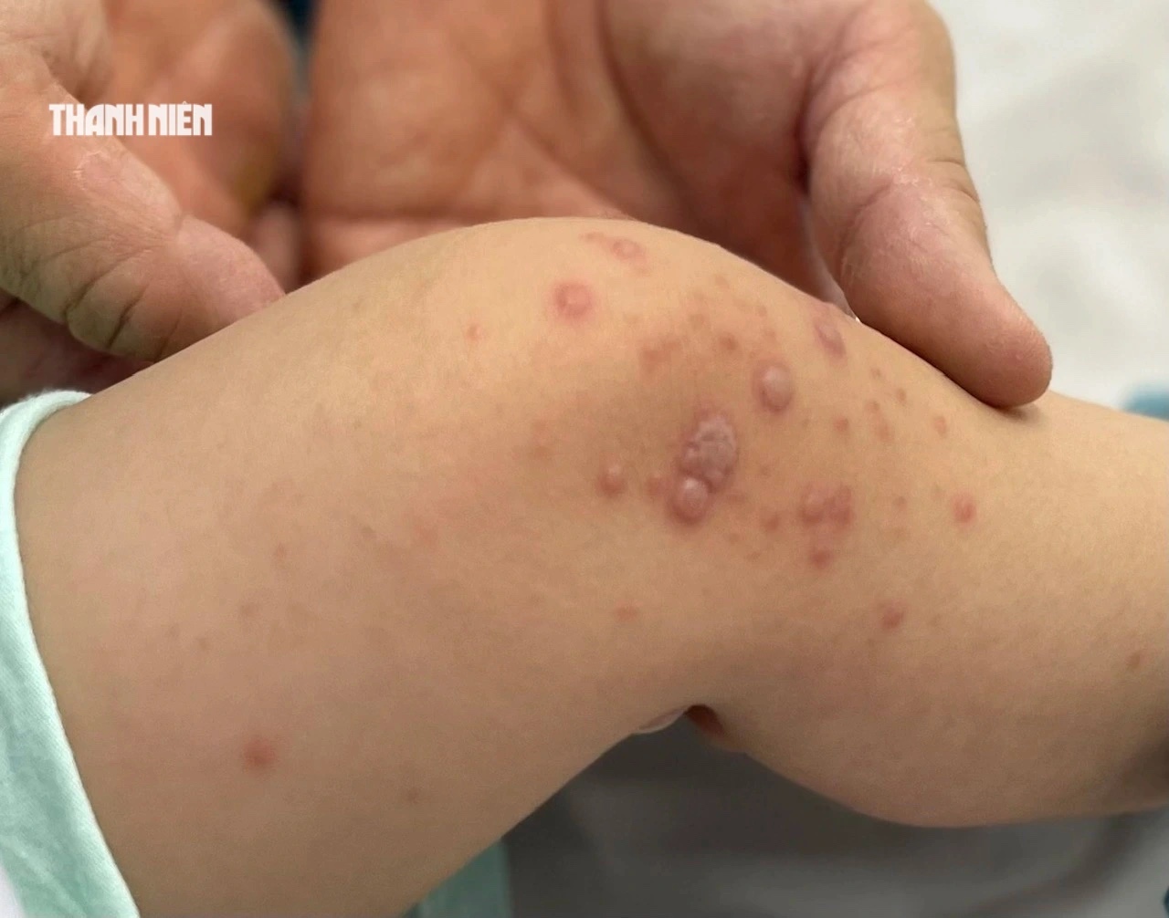 Bệnh tay chân miệng bùng phát: Vắc xin vẫn chưa có giá - Ảnh 1.