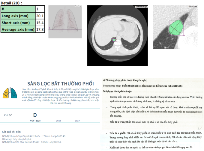 Hình ảnh và thông tin điều trị của một ca bệnh khó khi nốt bất thường ở phổi có kích thước lớn song bị che lấp, không phát hiện được thông qua chụp Xquang. Ảnh: T-Matsuoka Nura
