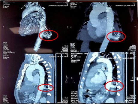 Việt Nam lần đầu dùng robot mổ điều trị phổi biệt lập thành công 1 Lần đầu dùng robot mổ điều trị phổi biệt lập thành công - Ảnh 1.