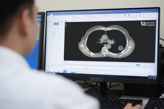 Bác sĩ lập kế hoạch xạ trị khối u ung thư phổi. Ảnh: Bệnh viện Đa khoa Tâm Anh