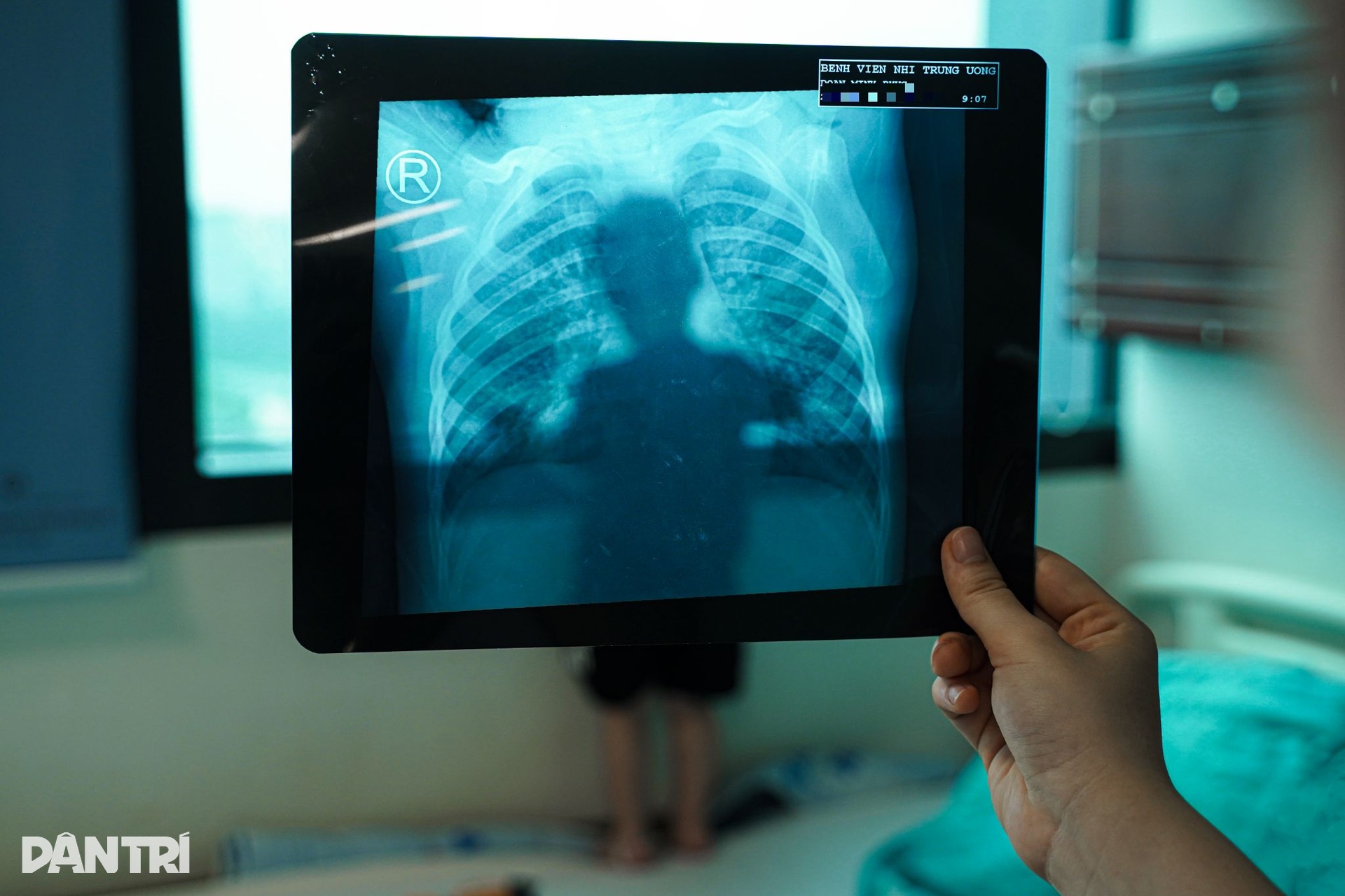 Hà Nội: Chỉ vài ngày ho sốt, nhiều trẻ đã viêm phổi nặng vì RSV - 14