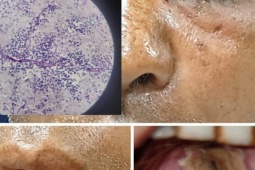 Người đàn ông ở Phú Thọ mắc bệnh tiểu đường bị hôn mê nguy kịch do nấm đen xâm lấn não