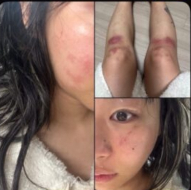 Nữ ca sĩ yêu lại bạn trai cũ từng đánh cô bầm dập toàn thân: “Tôi không kiện anh ấy nữa”- Ảnh 3.