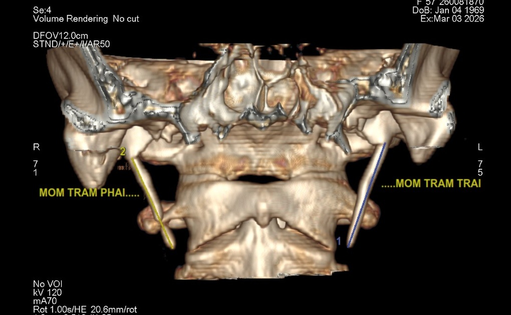 Đau họng dai dẳng 6 năm, người phụ nữ bất ngờ phát hiện bệnh hiếm khi đi khám - 2