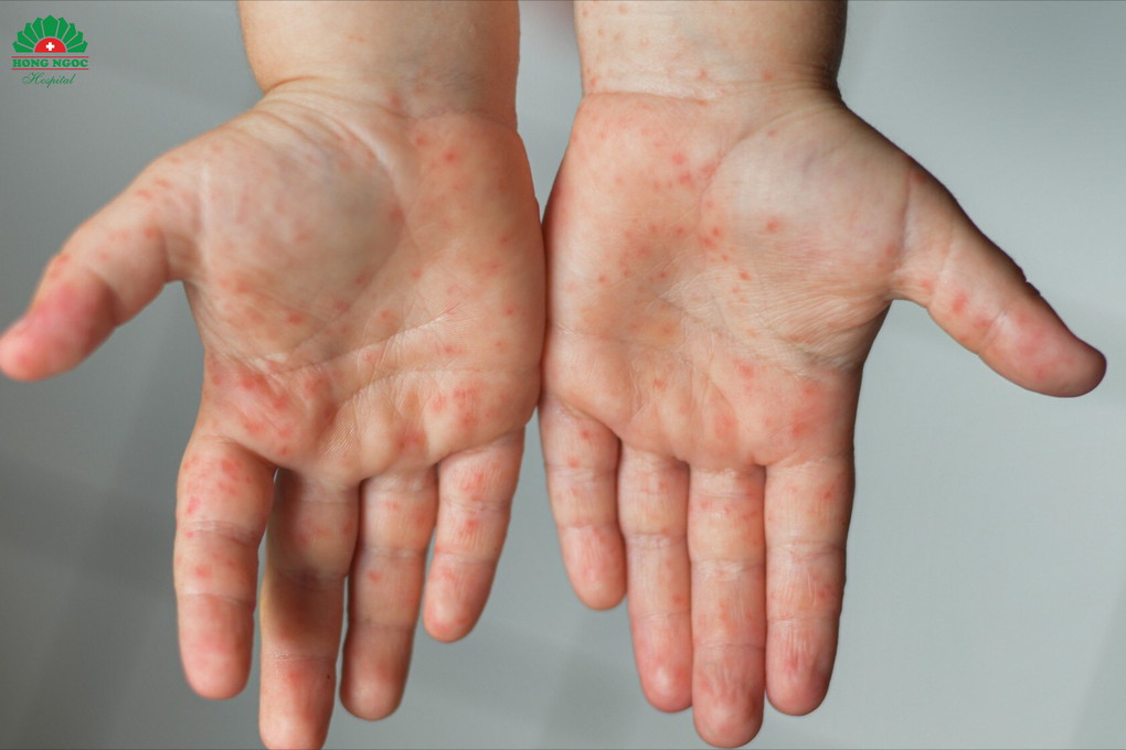 Cảnh báo tay chân miệng có thể tái nhiễm ngay khi trẻ mới khỏi bệnh - 2