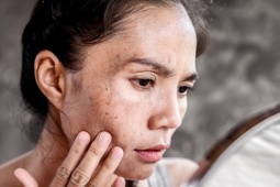 5 sai lầm khi dùng kem chống nắng khiến da sạm đen, nổi mụn