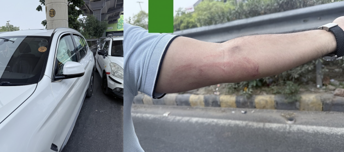 Túi khi bung do xung lực của mẫu BMW X3 2019, và vết thương trên tay tài xế do túi khi gây ra. Ảnh: Team-BHP