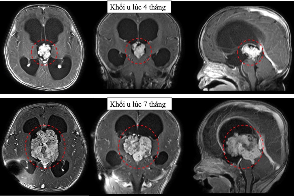 TPHCM: Cấp cứu cháu bé có khối u não to gấp ba lần chỉ trong 3 tháng - 2