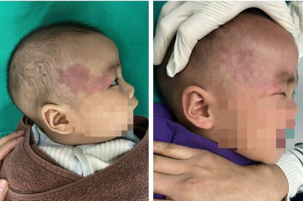 Bác sĩ cảnh báo hệ lụy bôi kem trộn, da nổi “mạng nhện đỏ” - 2