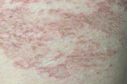 Người đàn ông ngứa dữ dội suốt 6 tháng không dứt, đi khám mới biết do thói quen nhiều người hay gặp