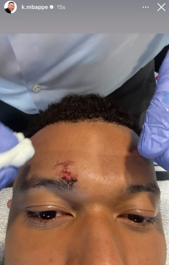 Kylian Mbappe đăng ảnh vết thương vùng trán.