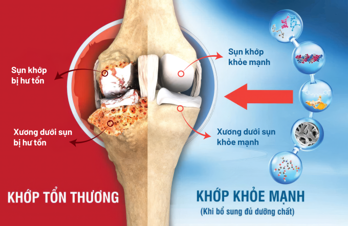Cấu tạo khớp khỏe mạnh và khớp bị tổn thương. Ảnh: Công ty Cổ phần Dược phẩm Eco