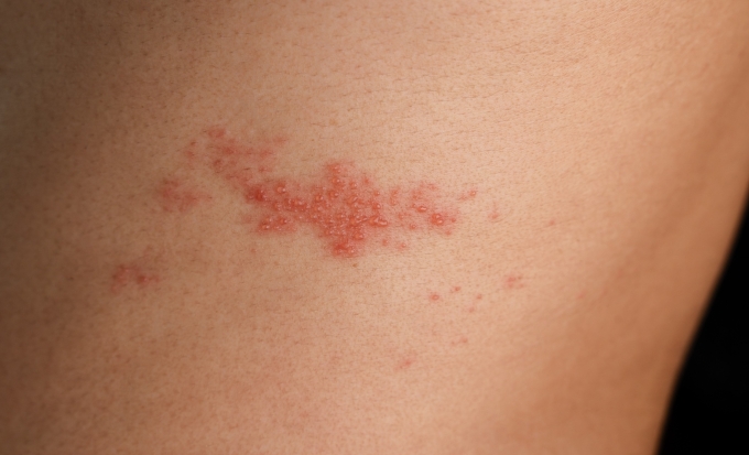 Những nốt mụn nước zona bị vỡ có thể lây bệnh cho vùng da lành. Ảnh: Vecteezy