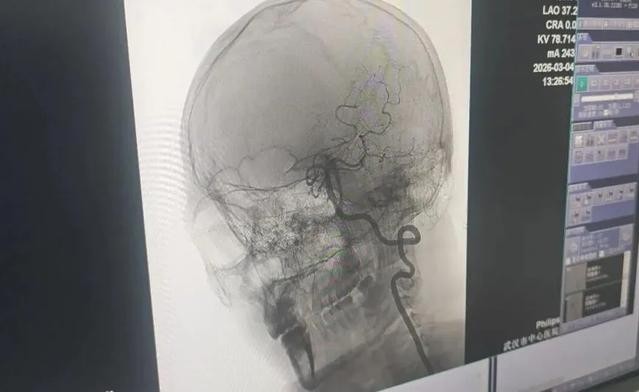 Đột quỵ ở tuổi 33 sau khi đi massage cổ vai gáy 1 Wang được can thiệp và tái thông thành công mạch máu bị tắc. Ảnh: Trường Giang nhật báo