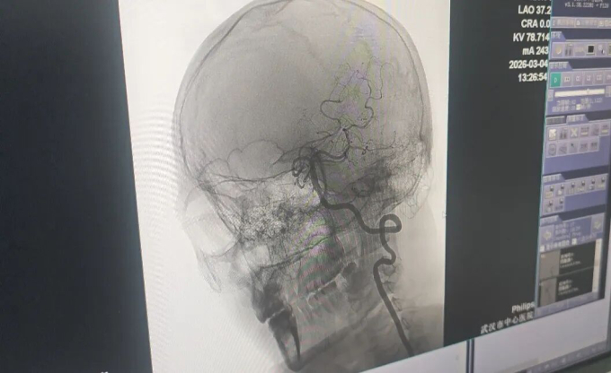 Đội ngũ y tế đã can thiệp và tái thông thành công mạch máu bị tắc của anh Vương. Ảnh: Li Huizi