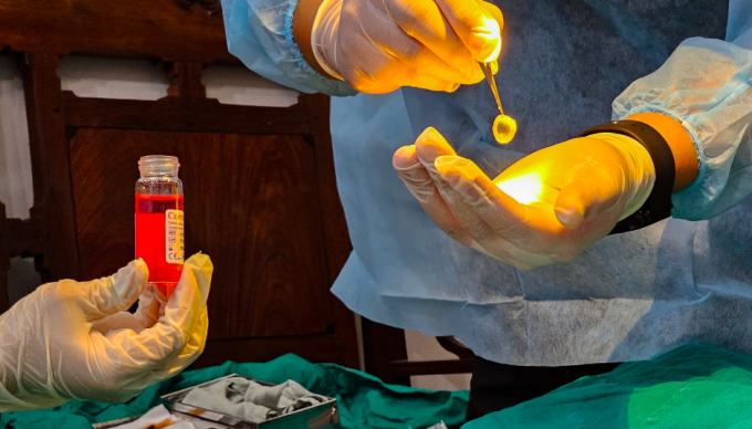 Giác mạc hiến lấy ra được đưa vào lọ bảo quản. Ảnh:Thùy Dương.