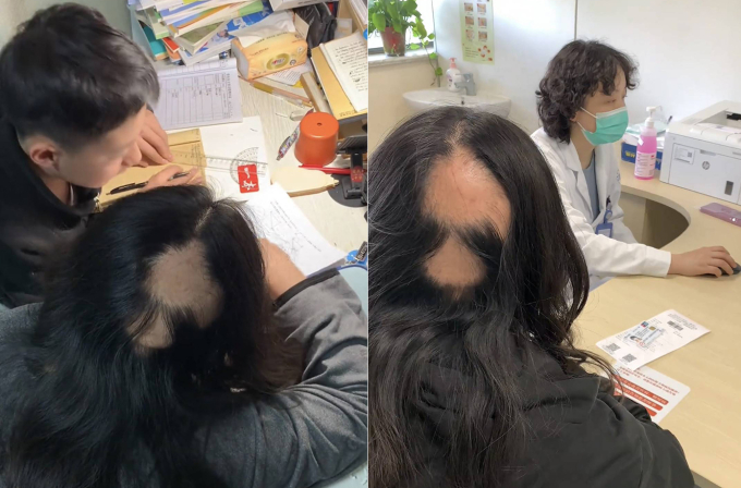 Tiêu bị rụng tóc từng mảng sau thời gian dài lo âu, căng thẳng vì thức đêm kèm con học. Ảnh: The Cover/Yangtse Evening Post