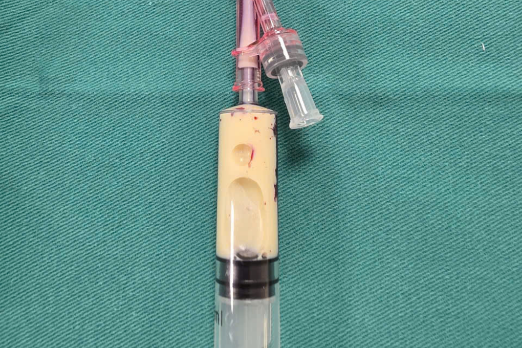 Mỡ máu tăng 100 lần, huyết tương trắng đục như sữa sau một buổi nhậu - 1