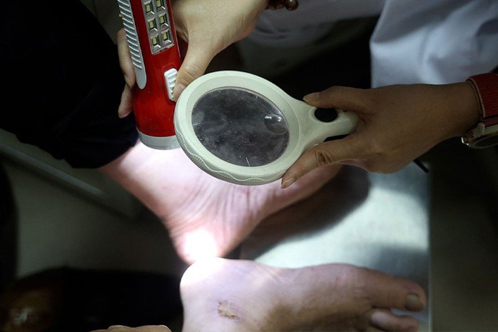 Sau chơi thể thao, nhiều người ngứa da, nổi mẩn vì nắng nóng 3 Bệnh nhân bị nấm da chân do đi giày kín trong nắng nóng. Ảnh: Dương Anh