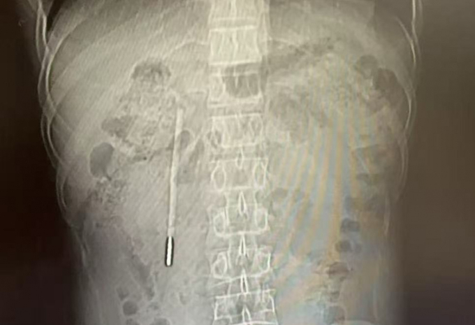 Phim chụp cho thấy một chiếc nhiệt kế thủy ngân trong bụng bệnh nhân. Ảnh: Wenzhou Metropolitan Daily