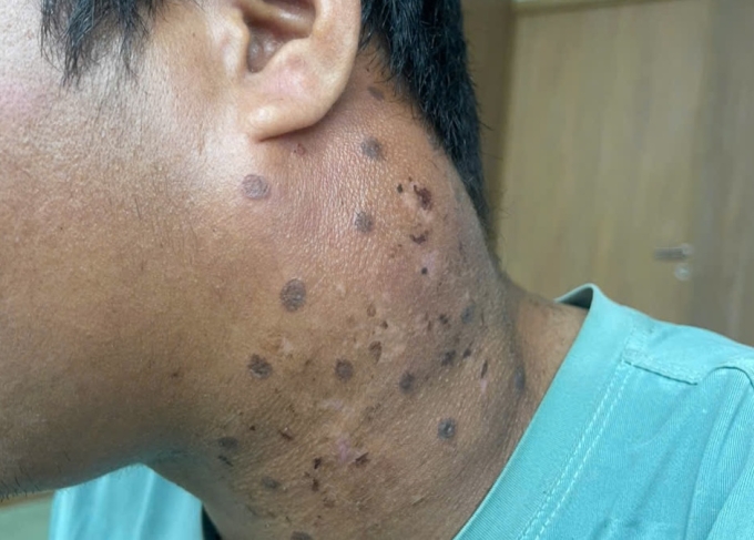 Vùng cổ của bệnh nhân sưng to, nhiều sẹo sau khi đốt nhang trị ung thư. Ảnh: Bác sĩ cung cấp