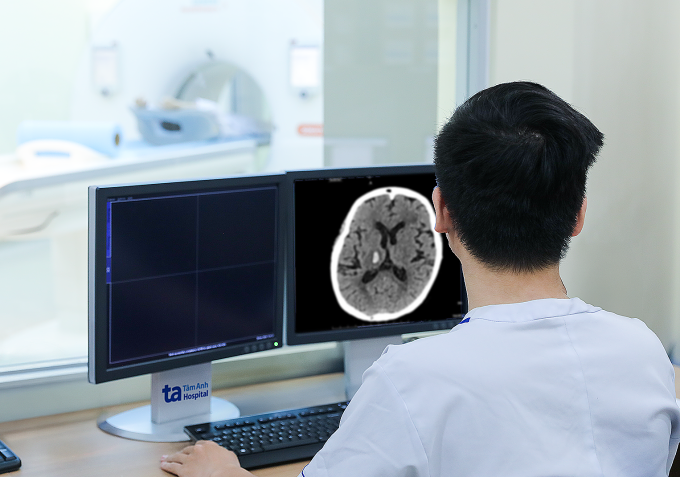 Bệnh nhân được chụp CT não phát hiện đột quỵ. Ảnh: Bệnh viện Đa khoa Tâm Anh